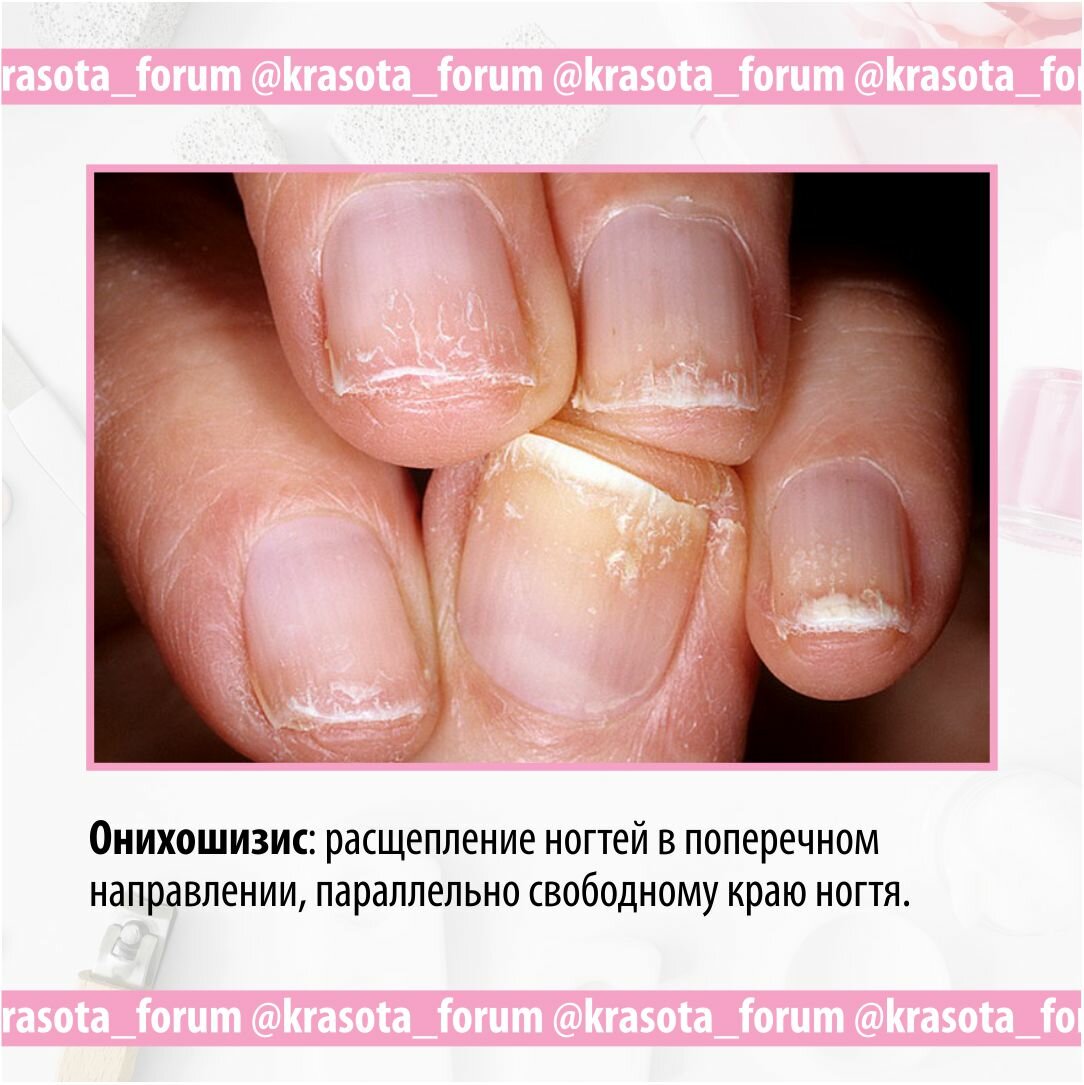 Виды поражений слизистой полости рта | стоматология в алтуфьево