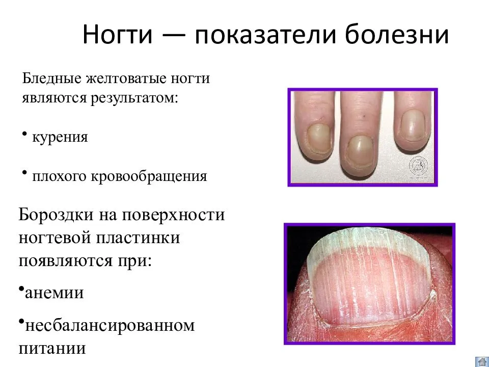Болезнь пузырчатка: симптомы, фото, лечение у детей и взрослых